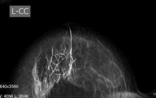 Внутрипроточная папиллома молочной железы