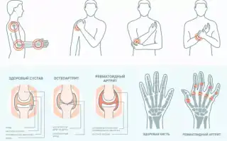 Артрит у детей