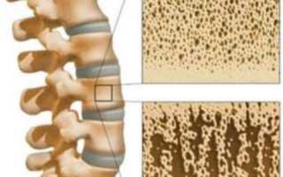Лечение остеопороза народными средствами