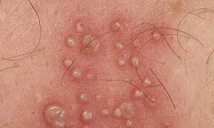 Водянистые пузырьки на коже: причины и лечение