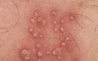Водянистые пузырьки на коже: причины и лечение