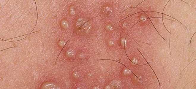 Водянистые пузырьки на коже: причины и лечение