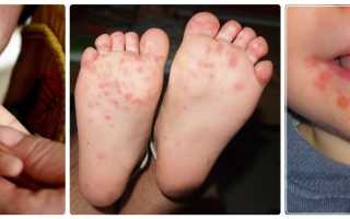 Сыпь на ладонях и ступнях ребенка: причины и лечение