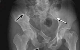 Перелом седалищной кости