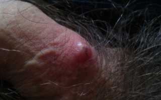 Почему появляются уплотнения на половом члене? Причины и последствия