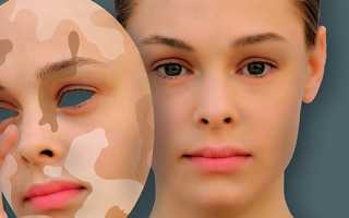 Белые пятна на лице — все про них и их причины