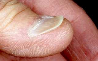 Почему загибаются ногти на руках: причины и рекомендации