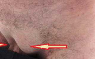 Паховая грыжа у мужчин — как проявляется, способы устранения и профилактика