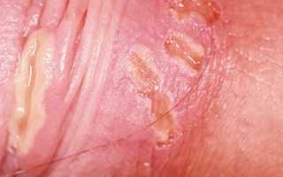 Заболевания члена фото