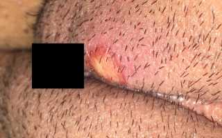 Язвочки на половых губах: причины и лечение