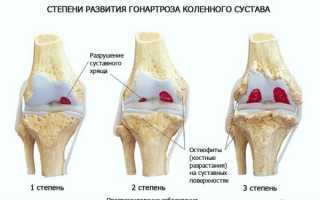 Лечение гонартроза коленного сустава 3 степени