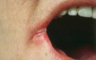 11 причин трещин в уголках рта и их лечение: полезные советы