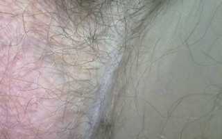 Шелушится кожа на мошонке — почему это происходит?