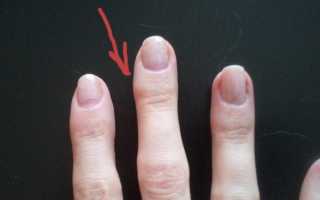 Шишка на суставе пальца руки: причины и лечение