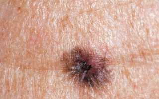 Как выглядит меланома кожи: важные аспекты и признаки