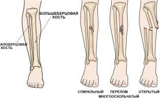 Перелом костей голени