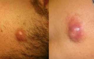 На коже появился нарост фото