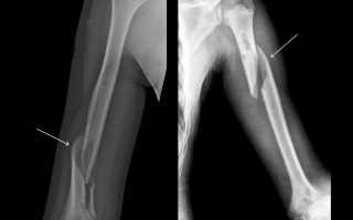 Перелом плечевой кости со смещением