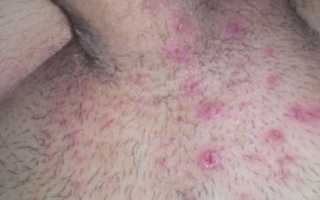 Прыщи на лобке: причины и лечение