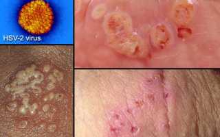 Высыпания на половых губах: причины и лечение