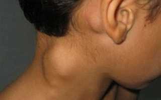Подкожное уплотнение на шее: причины и лечение