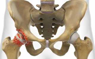 Лечение коксартроза тазобедренного сустава 2 степени