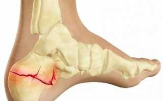 Перелом пятки со смещением и без