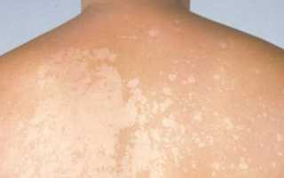 Сухие пятна на коже — почему появляются и как с ними бороться?