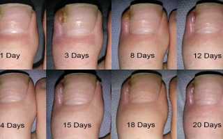 Вросший ноготь на большом пальце ноги — что делать с ним для облегчения?