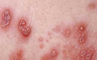 Сыпь на теле у взрослого: причины и лечение