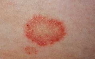Появились пятна на коже с красным ободком — это лишай или грибок? Узнайте причины и лечение.