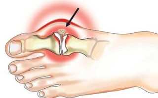 Снятие приступа подагры