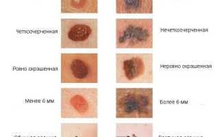 Черные точки на родинке: причины и лечение
