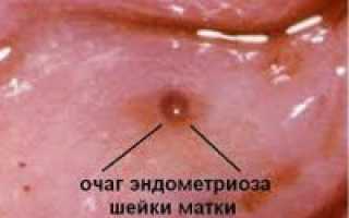 Лечение эндометриоза шейки матки