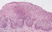 Дисплазия клеток плоского эпителия