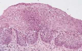 Дисплазия клеток плоского эпителия