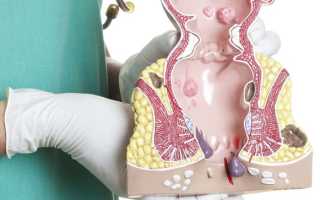 Трещины в заднем проходе: причины и лечение