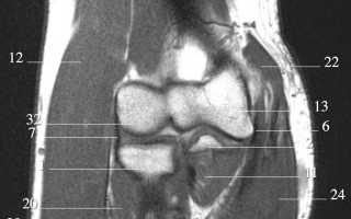 МРТ локтевого сустава