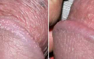 Почему появляются папилломы на половом члене? Причины и последствия