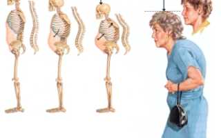 Остеопороз позвоночника