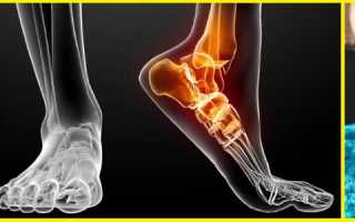 Периартрит голеностопного сустава
