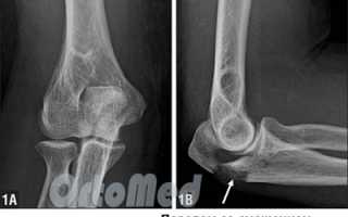 Перелом локтевой кости и сустава