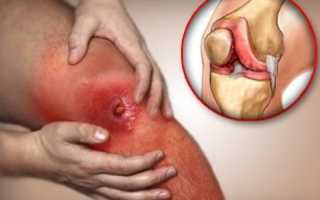 Инфекционный артрит