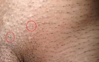 Папилломы на половых губах у женщин: причины и лечение