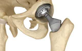 Эндопротезирование тазобедренного сустава
