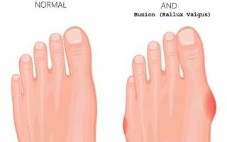 Бурсит большого пальца стопы