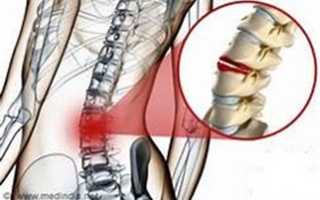 Компрессионный перелом позвоночника у детей
