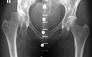 Диспластический коксартроз тазобедренного сустава