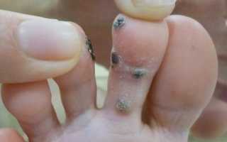Бородавка на пальце ноги — не приговор, а решение проблемы