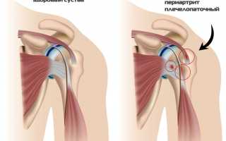 Плечелопаточный периартрит